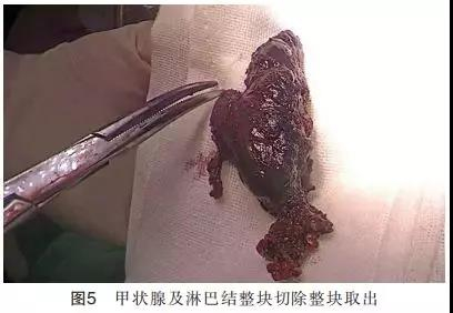 3 甲状腺切除及中央区淋巴结清扫  切开颈白线,显露甲状腺椎体叶及