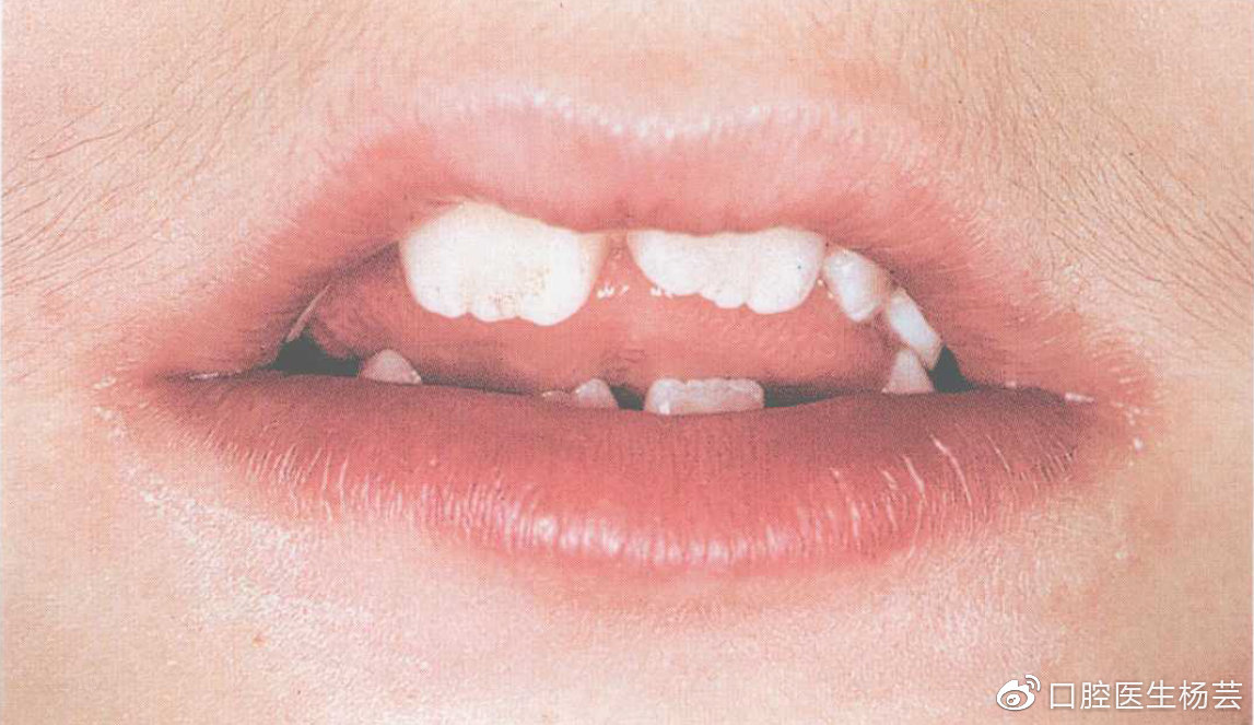 因长期未进行闭唇,上唇闭唇肌张力不足而呈现开唇露齿及有